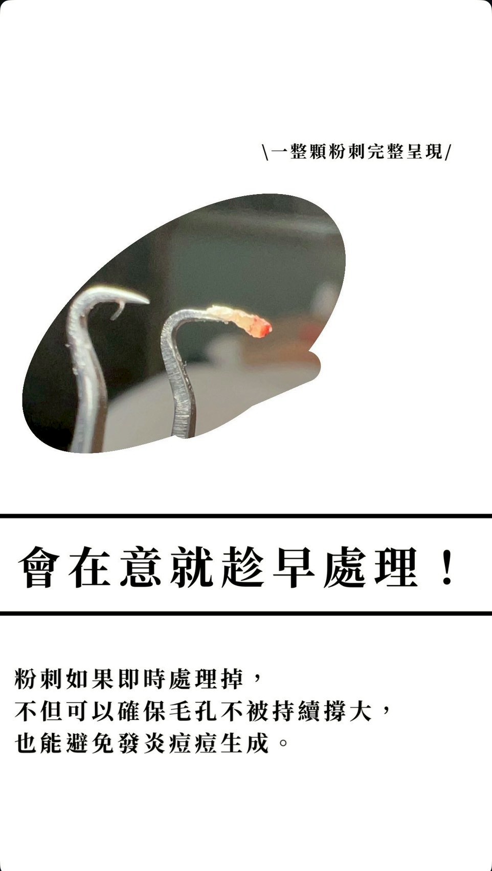粉刺處理